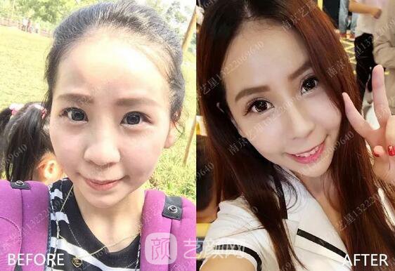 只需要5分鐘，我的鼻子變高了！——南京藝星玻尿酸隆鼻~