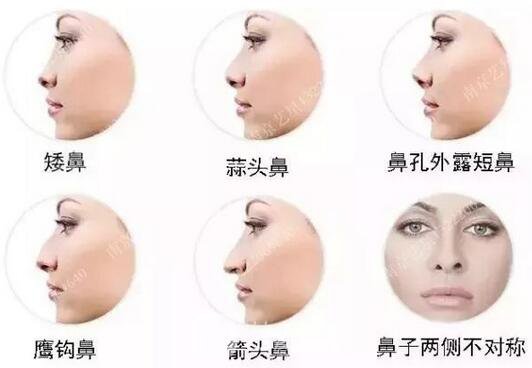 只需要5分鐘，我的鼻子變高了！——南京藝星玻尿酸隆鼻~