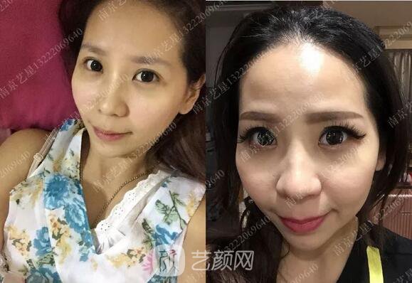 只需要5分鐘，我的鼻子變高了！——南京藝星玻尿酸隆鼻~