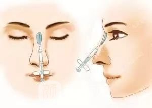 只需要5分鐘，我的鼻子變高了！——南京藝星玻尿酸隆鼻~