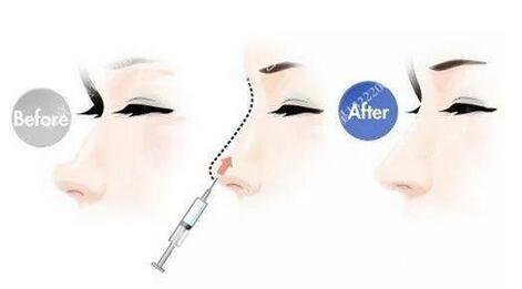 只需要5分鐘，我的鼻子變高了！——南京藝星玻尿酸隆鼻~