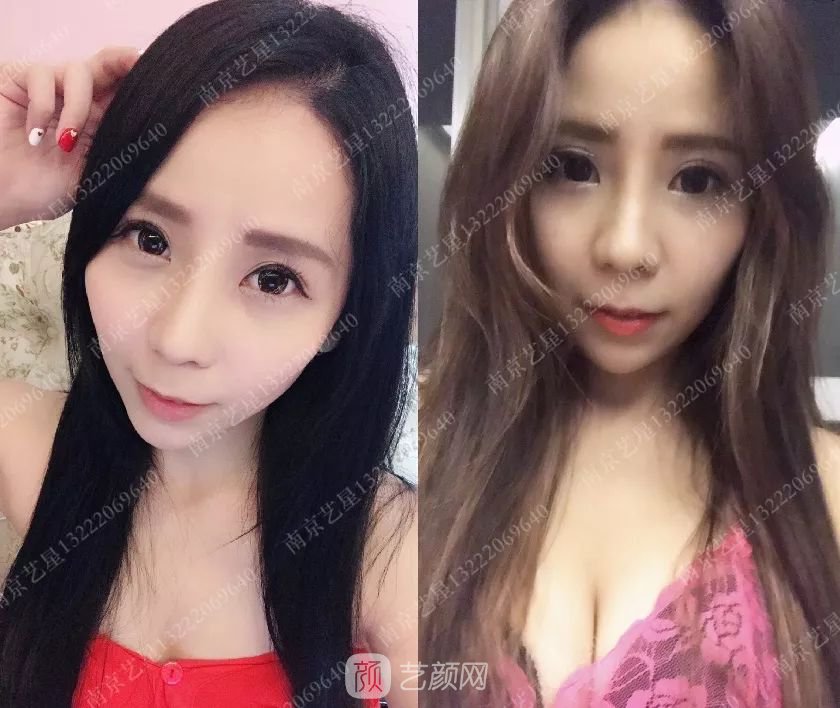 只需要5分鐘，我的鼻子變高了！——南京藝星玻尿酸隆鼻~