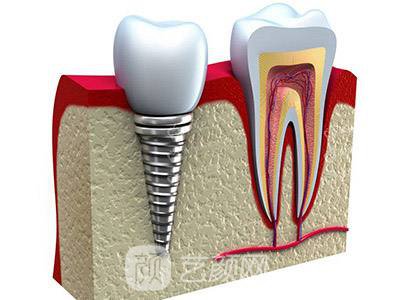 上海九院種植牙多少錢?