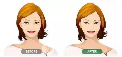 熱瑪吉除皺美眼的價格是多少錢