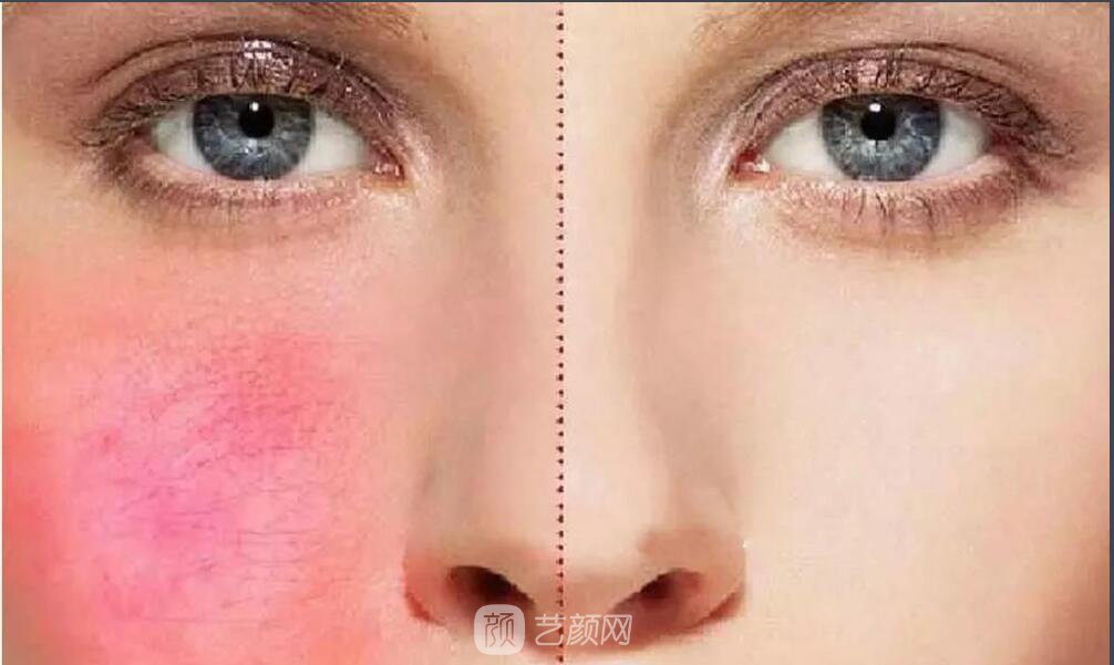 詳情解析紅血絲及毛孔粗大