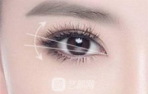 雙眼皮修復(fù)手術(shù)為什么這么難?