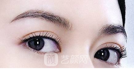 雙眼皮兩個月，是這個樣子的，大家來看看