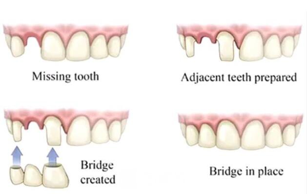做容冠，牙齒整齊又漂亮~