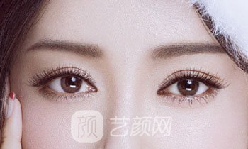 做完雙眼皮兩個(gè)月，簡(jiǎn)直跟換了個(gè)人似的