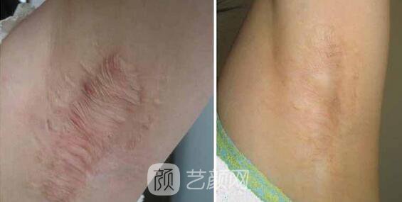 杭州激光去疤費用，多久見