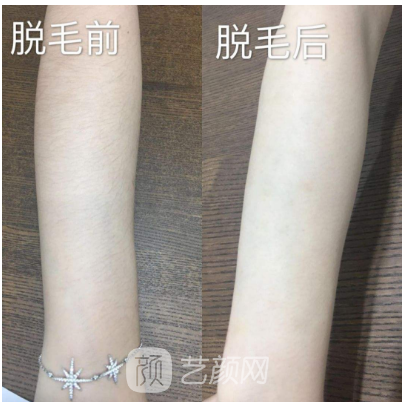 南昌紅蘋果做脫毛怎么樣?我們用實(shí)際情況來說話
