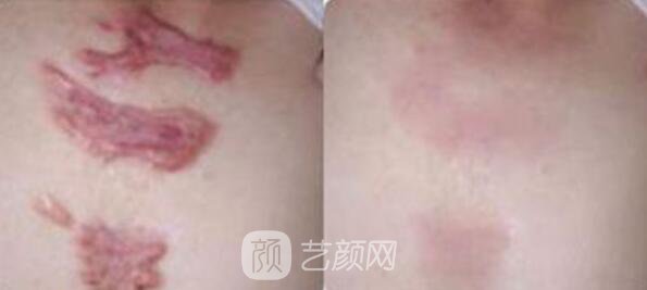 秦皇島專業(yè)去疤痕的醫(yī)院怎么樣?