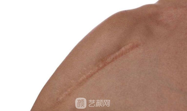 秦皇島專業(yè)去疤痕的醫(yī)院怎么樣?