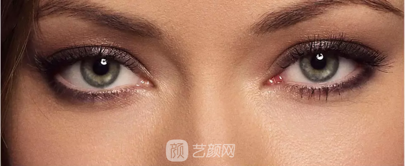 山東濱州雙眼皮手術(shù)貴嗎?多少錢?