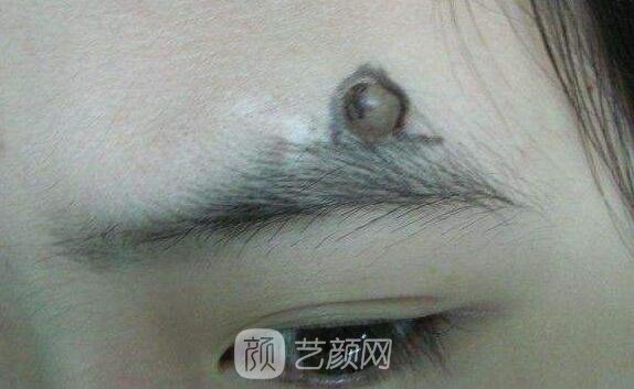 西安那里去痣更好，讓我這個專業(yè)醫(yī)生來告訴你