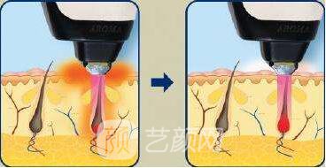 成都地區(qū)激光脫毛的價(jià)格是多少？