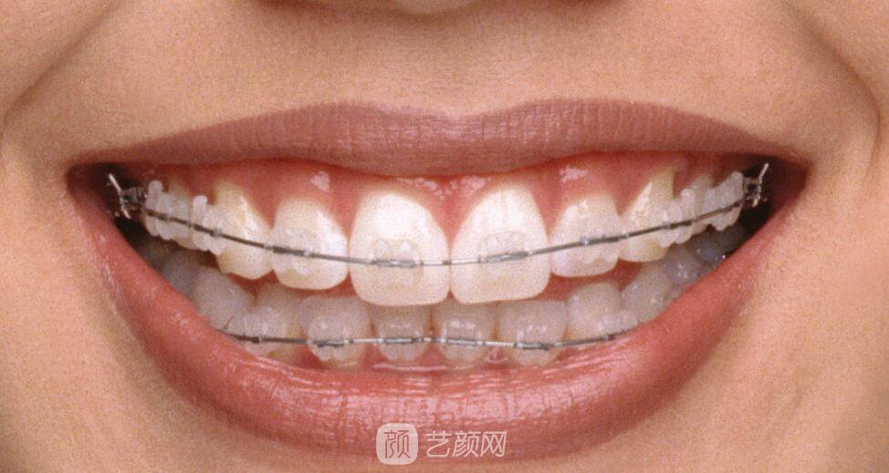 醫(yī)院牙齒矯正怎樣