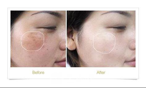 深圳金華城激光去疤多少錢(qián)