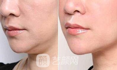 上海溶脂價(jià)格為什么沒有統(tǒng)一，當(dāng)?shù)爻錾t(yī)生為你解答