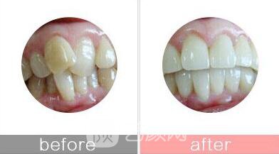 在菏澤矯正牙齒要多少錢