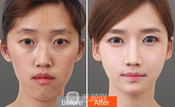 看我的韓式鼻子整形對照圖，前后差距是否很大