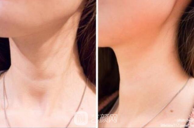 面部美容去皺果怎樣?請(qǐng)看真人案例