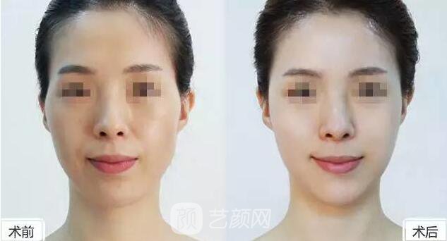 玻尿酸到底是什么東西，小編為你解剖分析