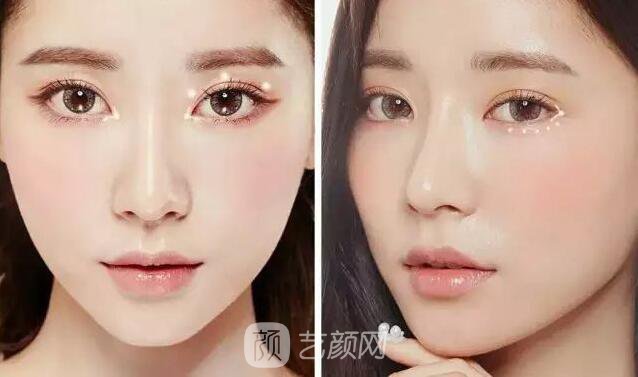 韓式切開雙眼皮的真實(shí)過程及恢復(fù)體驗(yàn)分享~~