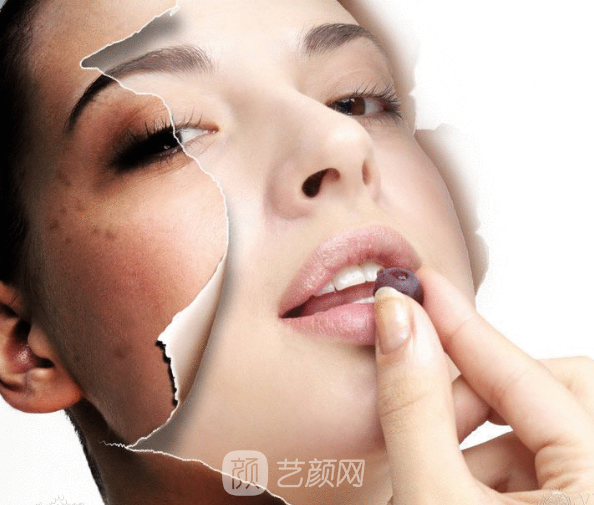 激光祛斑哪里好?恢復(fù)美麗肌膚解除煩惱