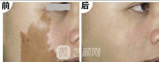 激光祛斑哪里好?恢復(fù)美麗肌膚解除煩惱