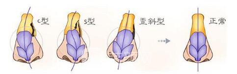 隆鼻失敗修復案例終于擁有滿意的鼻形