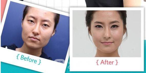 隆鼻失敗修復案例終于擁有滿意的鼻形