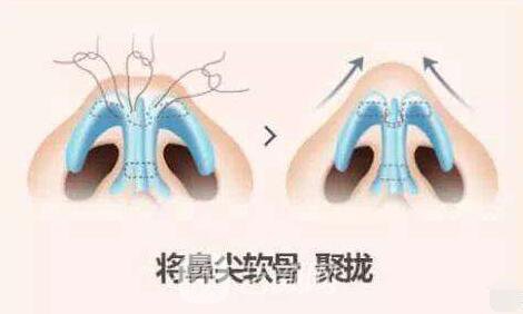 隆鼻果出來了朋友們都說好，大家如何看呢？