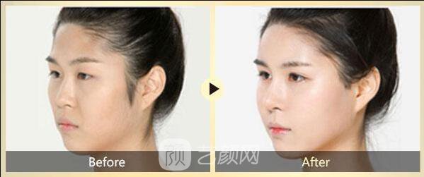 面部去皺術(shù)有很多，選適合自己的才是王道