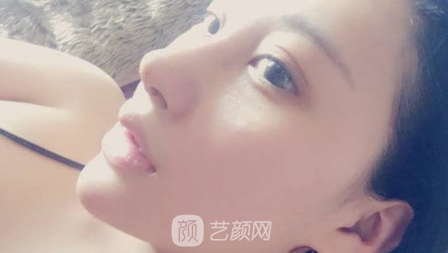 打注射瘦臉后臉真變小了，看來(lái)注射瘦臉真如傳聞所言