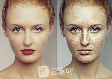 激光祛斑后，瞬間變剝殼雞蛋般白嫩光滑