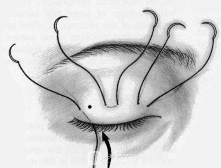 雙眼皮的恢復(fù)與外界影響有關(guān)嗎?