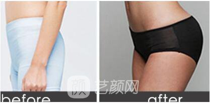 重慶埋線減肥怎么樣？