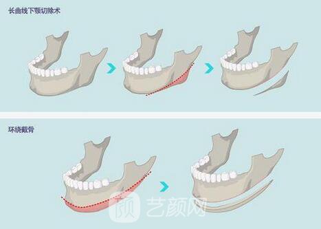 西昌整形專家湯穎峰：如何減少腮腺和頜下腺肥大？