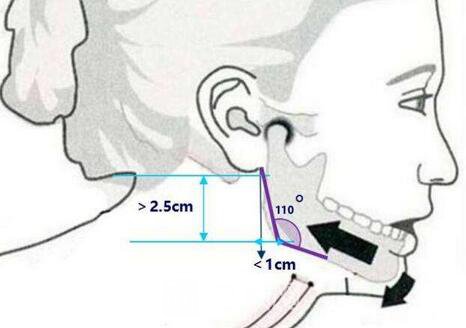西昌整形專家湯穎峰：如何減少腮腺和頜下腺肥大？