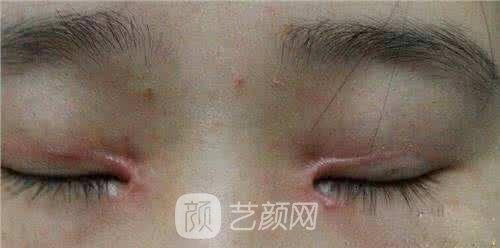 雙眼皮手術(shù)傷疤