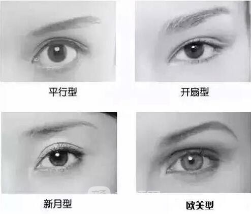 雙眼皮手術(shù)類型