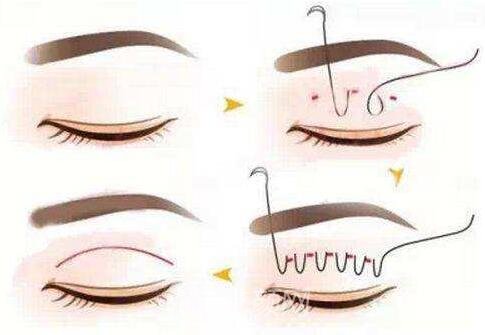 埋線雙眼皮手術(shù)流程