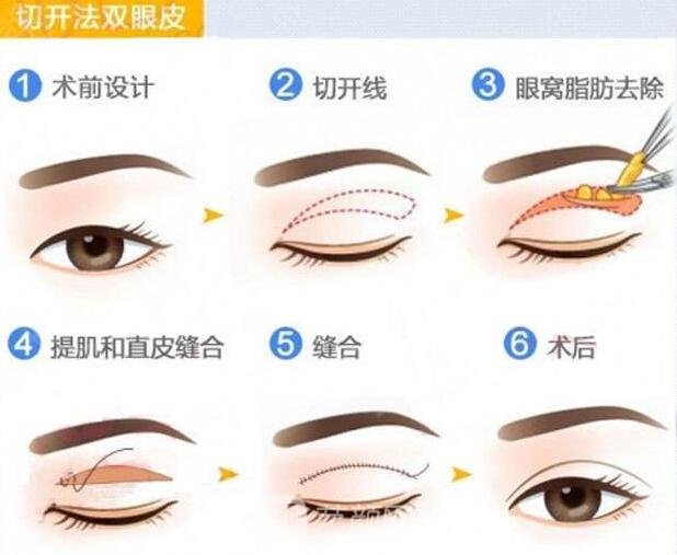 全切雙眼皮手術(shù)流程