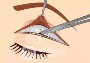全切雙眼皮手術(shù)