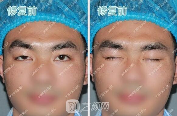 雙眼皮手術(shù)案例術(shù)后果