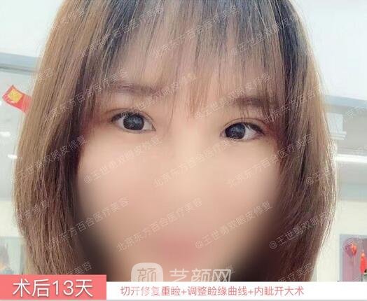 修復(fù)雙眼皮術(shù)后13天果