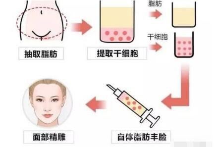 自體脂肪填充步驟