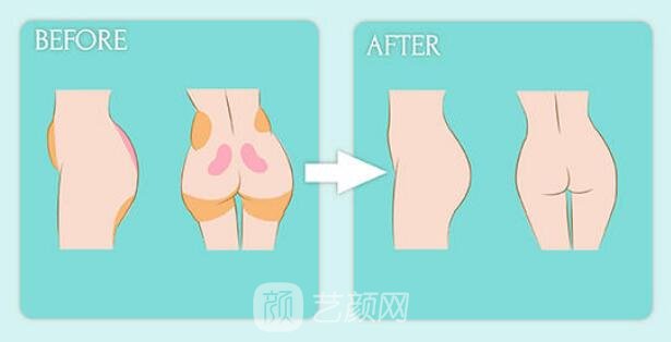 做自體脂肪豐臀要腫多久？做這些事可以加速消腫喲！