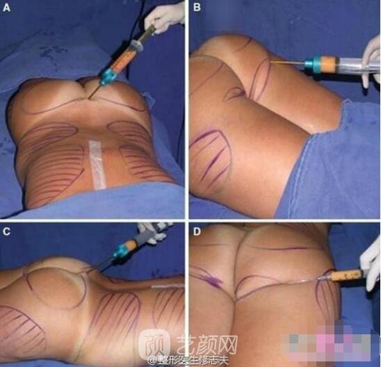 自體脂肪豐臀手術步驟圖